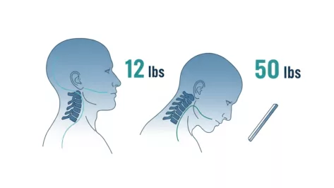 Illustration comparing upright neck posture at 12 lbs of head weight with forward head posture creating 50 lbs of neck strain.